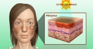 Como Tratar O Melasma Em Casa E Ter Um Excelente Resultado Sem Efeito