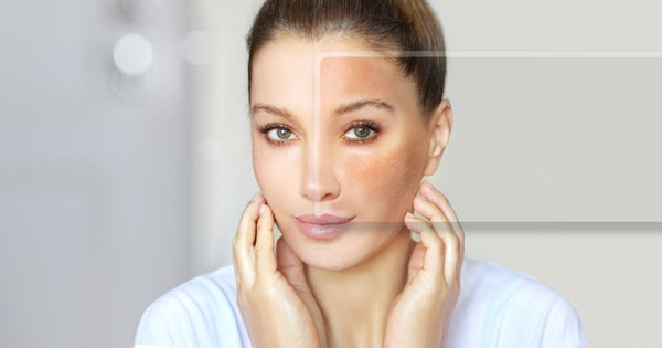 Peptídeos no tratamento do melasma: como eles auxiliam na regeneração da pele