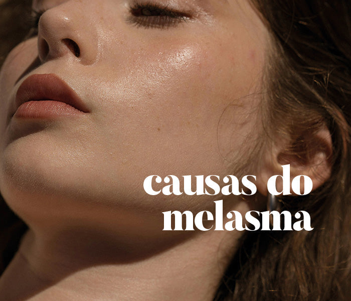 Causas do Melasma que podem estar agravando