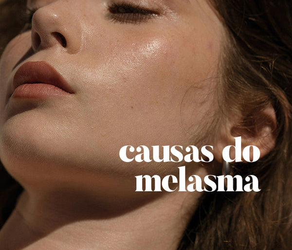 Causas do Melasma que podem estar agravando