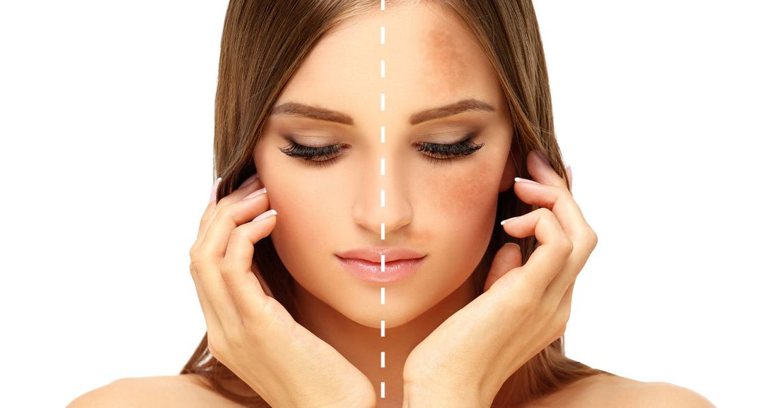 antioxidantes na prevenção do agravamento do melasma