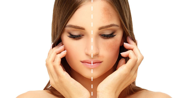 antioxidantes na prevenção do agravamento do melasma