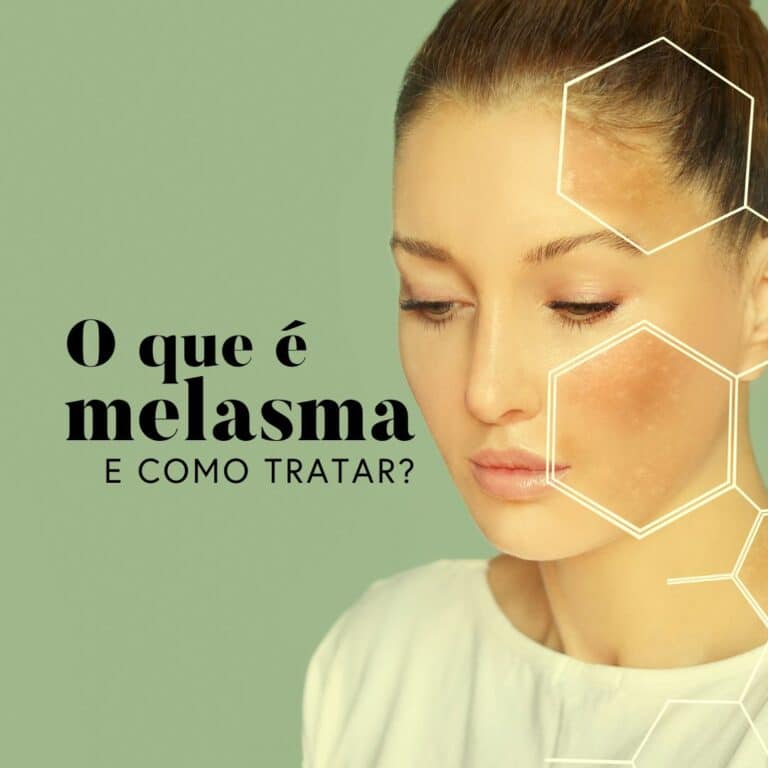 o que é melasma e como tratar