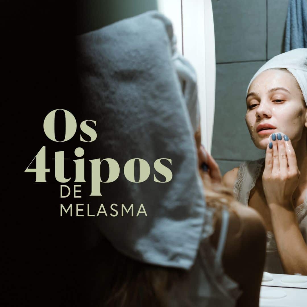 tipos de melasma