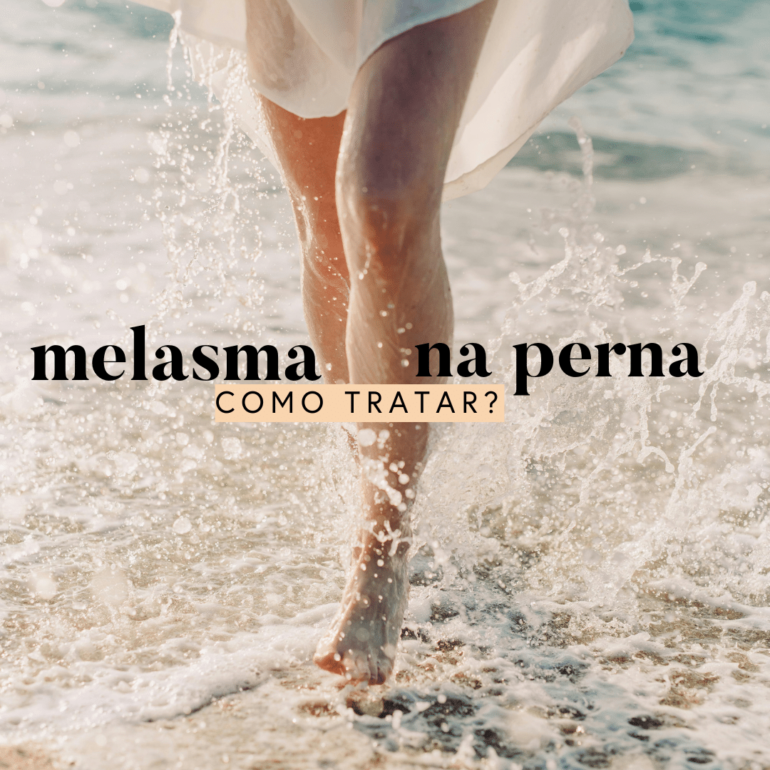 melasma na perna