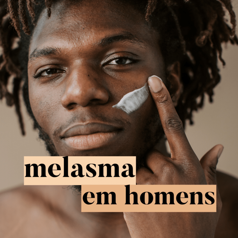 melasma em homens