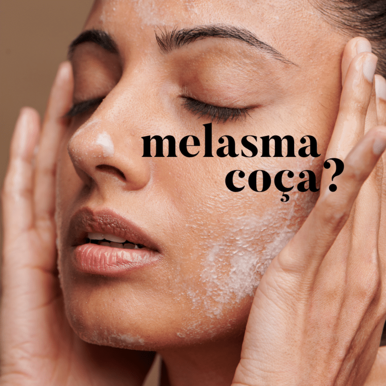 melasma coca