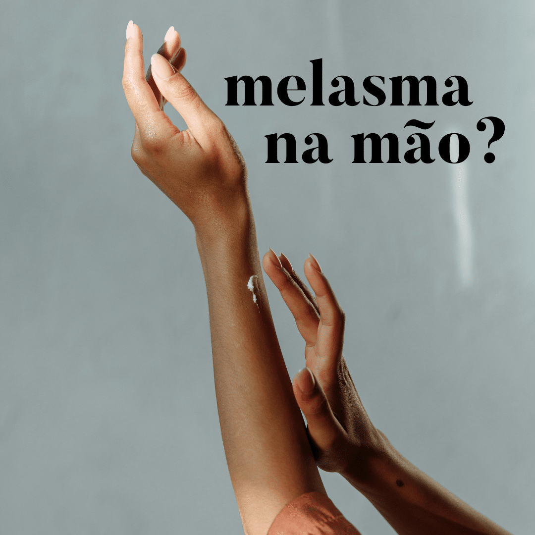 melasma na mão